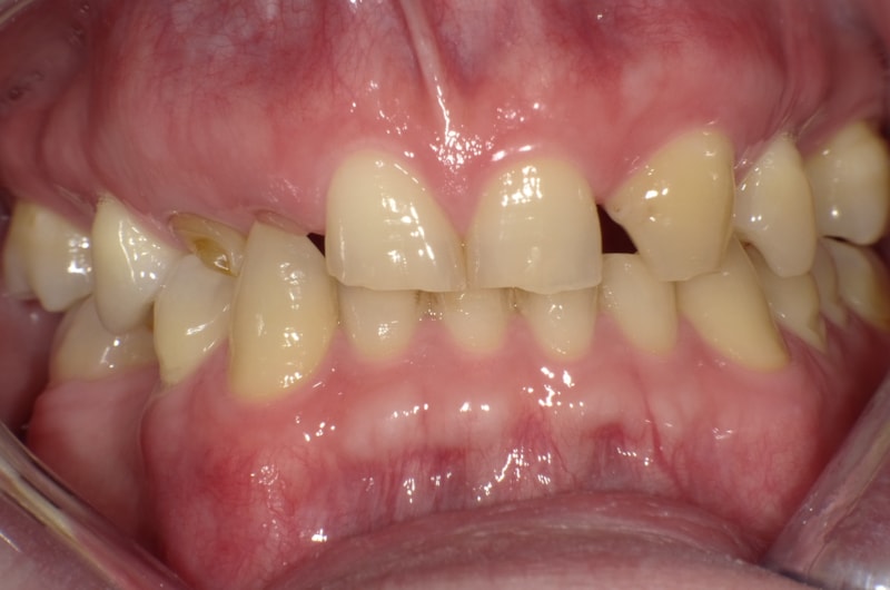 Teilweise Nichtanlage bleibender Zähne mit teilweise noch vorhandenen Milchzähnen, abgesunkener, lückiger Bisslage